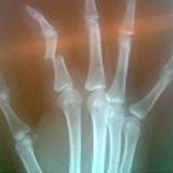 Broken Finger Session
