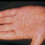 The Natural Health Show 4 (Eczema)