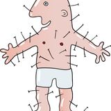 Acupuntura