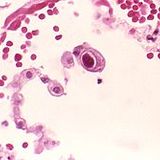 Cytomegalovirus