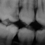 Menthos - 20th february 2015 (no two teeth)