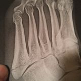 Drag Race Foot Fatality