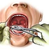 Tooth Extraction