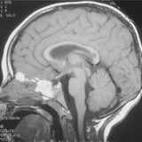 Ciaran Chevalier - Subdural Haematoma (Minimal & Tech House Mix) (March 2013)