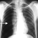 PNEUMOTHOMIX