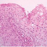Condylomes