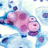 Chlamydia