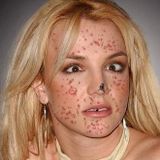 Acnephobe