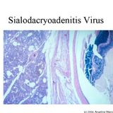sialodacryoadenitis