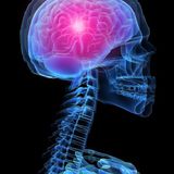 Neurosurgical_Stroke_#_0.1