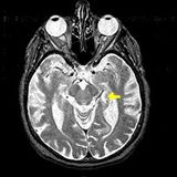 Amygdala