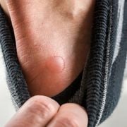 Learn How to Prevent Blisters on Arch & Inside of Foot When Running - Audio Blog