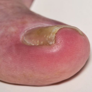 What Is Onychocryptosis? ICD-10 Definition and Medical Meaning Explained - Audio Blog