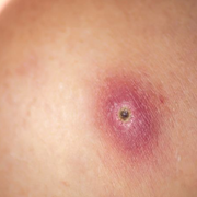 Small Scabs and Skin Sores That Won't Heal: Discovering Causes & Treatment - Audio Blog