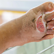 What Does an Infected Cut Look Like? Signs, Symptoms & Pictures - Audio Blog