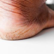 What Fungus Pathogen Causes Athlete's Foot? Signs of Early Stage - Audio Blog