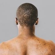 Immune Idiopathic Thrombocytopenic Purpura Causes: Briefly Explained - Audio Blog