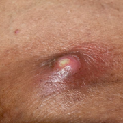 Why Do I Keep Getting Abscesses? Uncovering Hidden Causes & Lasting Solutions - Audio Blog