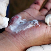 Medline Plurogel: Advanced Burn and Wound Dressing for Optimal Healing - Audio Blog