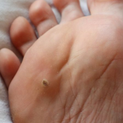 Corn Vs Wart - How to Tell the Difference Between Corns and Plantar Warts on the Bottom of Your Foot