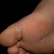 How to Get Rid of a Plantar Wart Quickly and Naturally at Home Using Safe Remedies - Audio Blog
