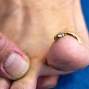 Discovering Onychomycosis (Tinea Unguium) | Complete ICD-10 Definition and Medical Meaning