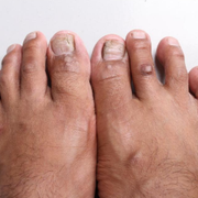 Early Stage Diabetes: Recognizing Foot Signs, Symptoms, and Issues - Audio Blog
