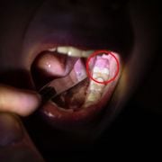Pediatric Infant & Child Abscess on Gum Near Tooth: Causes, Symptoms, and Common Treatments