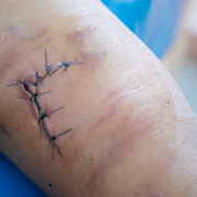 Is My Cut Infected? How To Tell if A Wound Abscess Is Infected or Just Healing - Audio Blog