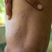 Do Blood Clots Look Like Bruises? Discovering How to Tell the Difference - Audio Blog