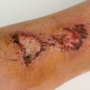 What Are The Top Causes of Delayed and Slow Healing Wounds on Body & Legs - Audio Blog
