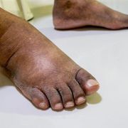 What Is the Difference Between Sesamoiditis Vs Gout: How to Know Its Causes - Audio Blog