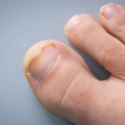 Fungal Nail Bed Infection: Toenail Fungus ICD-10 Definition and What Its Early Stages Look Like