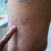 Popliteal Vein Thrombosis Symptoms, Causes & Treatment - Audio Blog