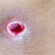 Abscess vs. Cyst vs. Boil: Key Differences Briefly Explained - Audio Blog