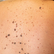 What Are Purpura Simplex Skin Rash and Bruises? Are Purpura Spots Dangerous? - Audio Blog