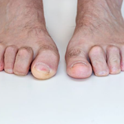 What Is Mallet Toe Deformity and Its Causes? - Audio Blog
