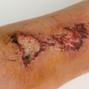 The Science of Healing: How Your Body Repairs Wounds in 4 Essential Stages - Audio Blog