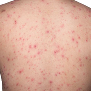 Ecchymosis vs. Petechiae: A Closer Look Through First-Hand Clinical Insights - Audio Blog