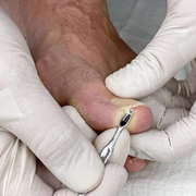 First Stage Ingrown Diabetic Toenails: Treatment & Safe Cutting Techniques - Audio Blog