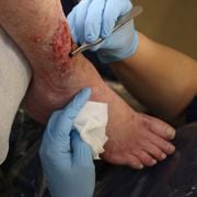 Discovering Venous Insufficiency Leg Ulcer ICD-10, Causes & Pictures - Audio Blog