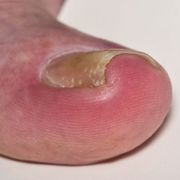Swollen Infected Toe? The Signs and Causes of Bacterial and Fungal Ingrown Toenail Infections