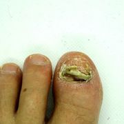 What's the Difference Between Toenail Mold Vs Fungus? How to Spot the Subtle Signs and Treat Them