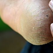 Different Types of Foot Fungus: Treatments and What It Looks Like - Audio Blog