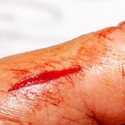 How Long Does It Take for a Laceration Wound or Deep Cut to Heal? - Audio Blog