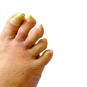 Onychogryphosis (Ram's Horn Toenail) - Definition & Treatment - Audio Blog