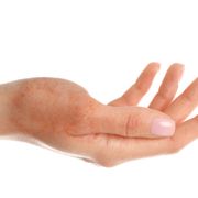 Top Insights From Experts On 2nd Degree Burn Blister Healing Stages - Audio Blog