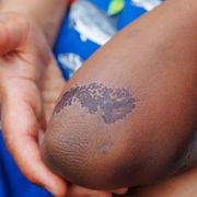 Expert Tips on How to Stop a Healing Wound From Itching Under a Dressing - Audio Blog
