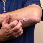 Why Do Healing Wounds and Cuts Itch? It's Science Explained - Audio Blog