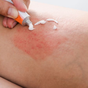 The Importance of Rash Treatment via Ointment and Cream for Adults - Audio Blog
